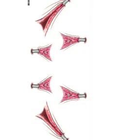 Stretched trauma tatovering